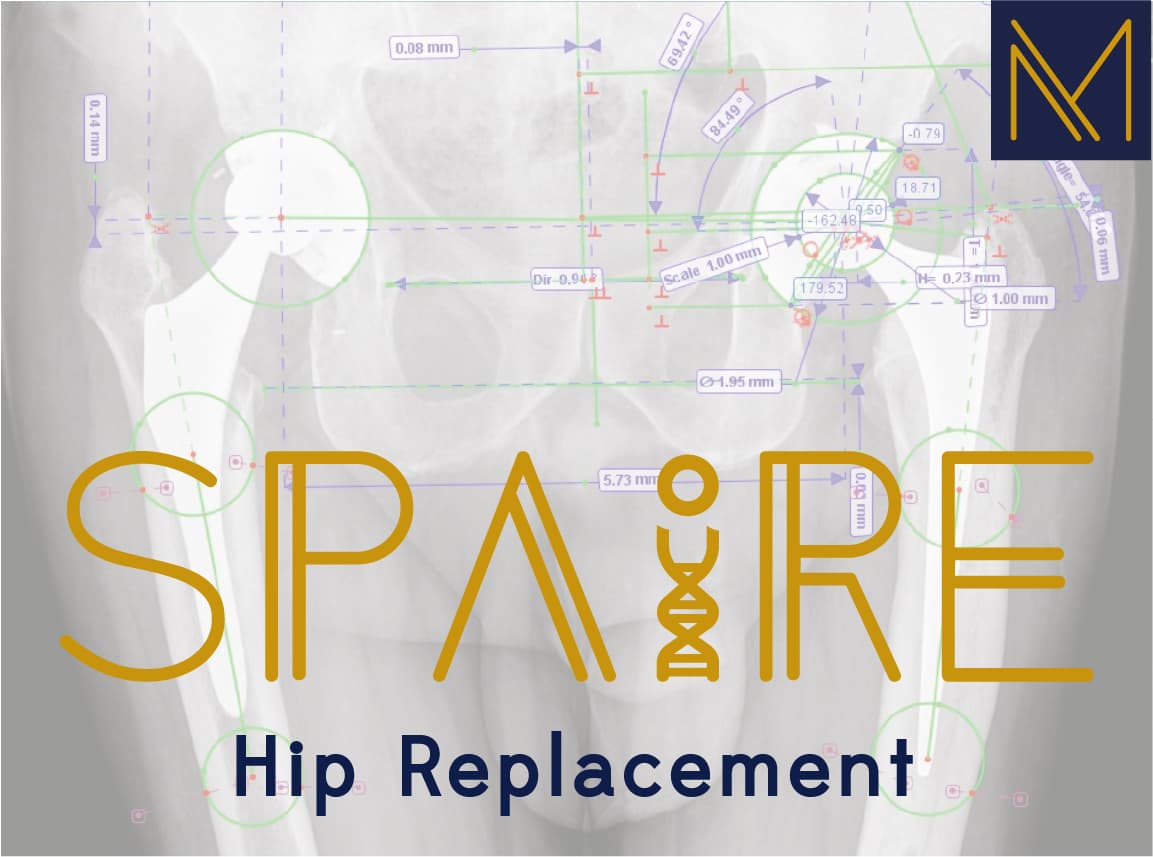 SPAIRE hip replacement technique diagram